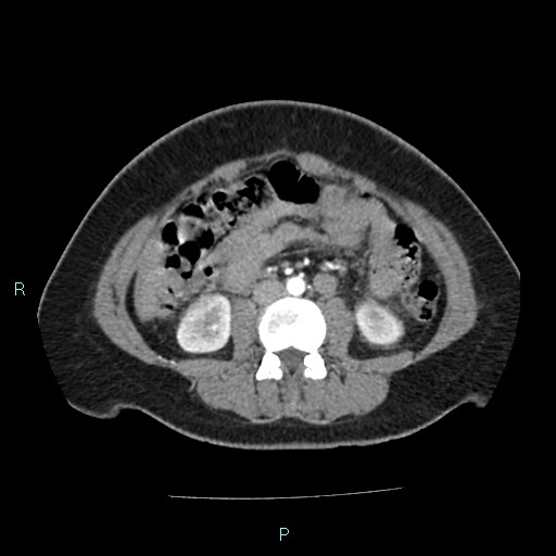 Acute bilateral pyelonephritis (Radiopaedia 37146-38881 Axial C+ arterial phase 103).jpg