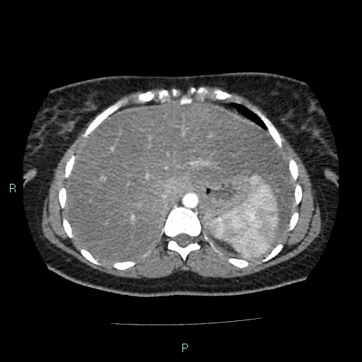 Acute bilateral pyelonephritis (Radiopaedia 37146-38881 Axial C+ arterial phase 23).jpg