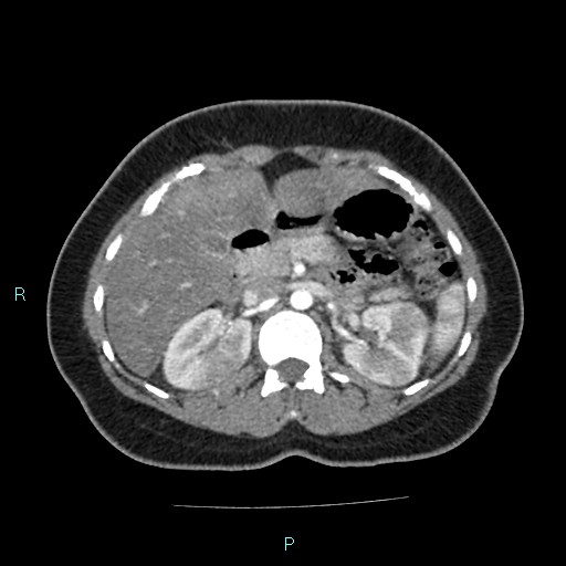 File:Acute bilateral pyelonephritis (Radiopaedia 37146-38881 Axial C+ arterial phase 65).jpg