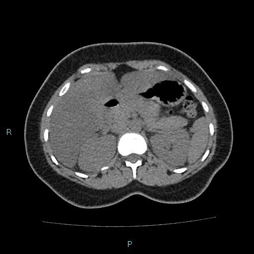 Acute bilateral pyelonephritis (Radiopaedia 37146-38881 Axial non-contrast 35).jpg