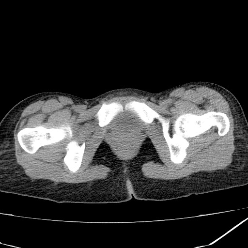 Acute bilateral pyelonephritis (Radiopaedia 74153-84969 Axial non-contrast 51).jpg