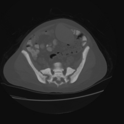 Acute calculous cholecystitis in patient with osteopetrosis (Radiopaedia 77871-90159 Axial bone window 38).jpg