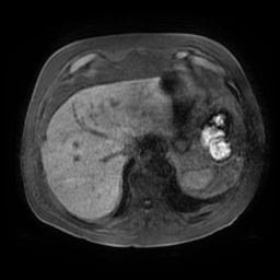 Acute cholecystitis complicated by pylephlebitis (Radiopaedia 65782-74915 Axial T1 fat sat 17).jpg