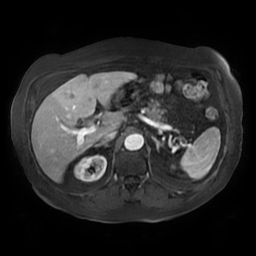 File:Acute cholecystitis complicated by pylephlebitis (Radiopaedia 65782-74915 Axial arterioportal phase T1 C+ fat sat 50).jpg