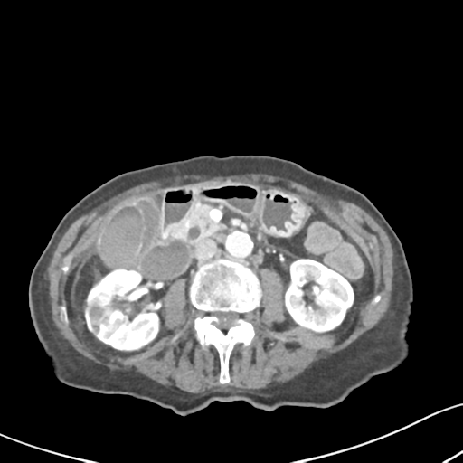 File:Acute cholecystitis with contained perforation (Radiopaedia 47328-51907 Axial C+ portal venous phase 32).png