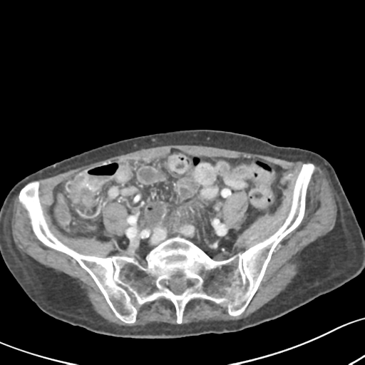 Acute cholecystitis with contained perforation (Radiopaedia 47328-51907 Axial C+ portal venous phase 52).png