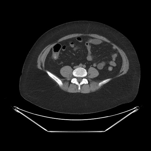 File:Acute cholecystitis with tensile fundus sign (Radiopaedia 71394-81723 Axial non-contrast 69).jpg