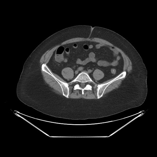 Acute cholecystitis with tensile fundus sign (Radiopaedia 71394-81723 Axial non-contrast 77).jpg