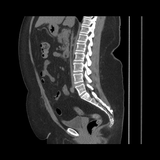 Acute cholecystitis with tensile fundus sign (Radiopaedia 71394-81723 Sagittal non-contrast 86).jpg