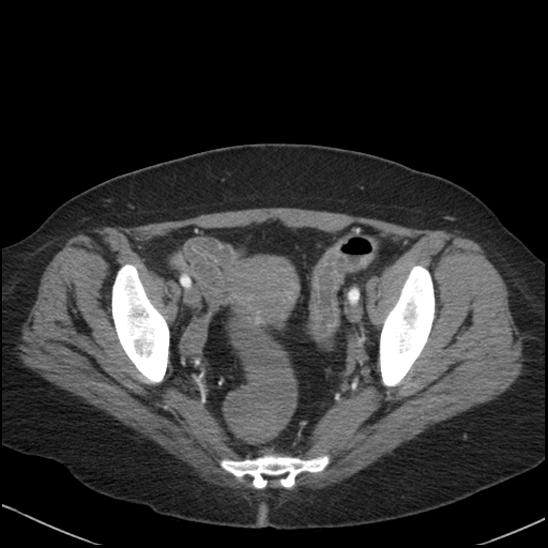 Acute colonic hemorrhage in ulcerative colitis (Radiopaedia 77415-89538 Axial C+ arterial phase 114).jpg
