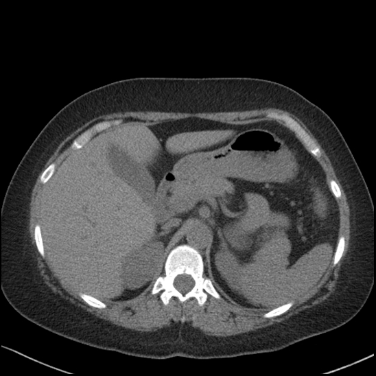 Acute colonic hemorrhage in ulcerative colitis (Radiopaedia 77415-89538 Axial non-contrast 36).jpg