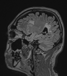 Acute disseminated encephalomyelitis (ADEM)- Anti-NMDA receptor encephalitis (Radiopaedia 54920-61201 Sagittal FLAIR 58).png