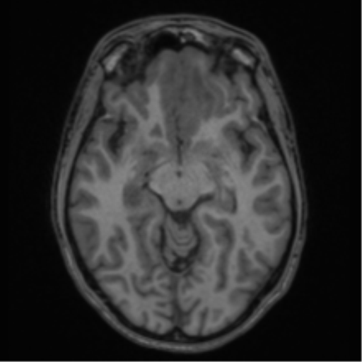 Acute disseminated encephalomyelitis (ADEM) (Radiopaedia 65319-74349 Axial T1 26).png