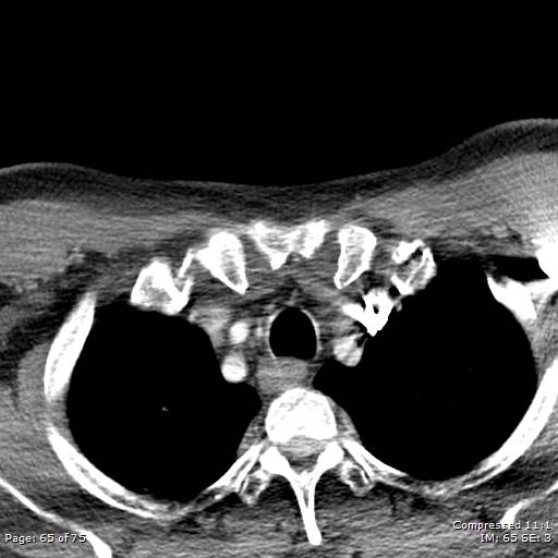 Acute epiglottitis (Radiopaedia 54375-60590 Axial C+ arterial phase 65).jpg