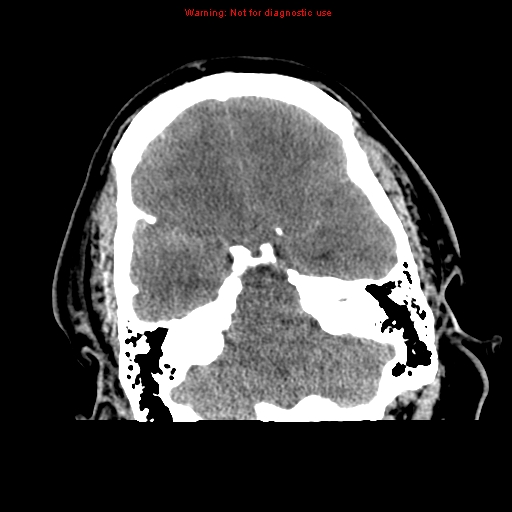 File:Acute hemorrhagic leukoencephalitis (Radiopaedia 14076-72275 Axial non-contrast 9).jpg