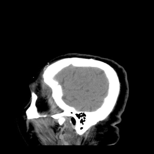 File:Acute hemorrhagic stroke (Radiopaedia 17507-17223 Sagittal non-contrast 41).jpg