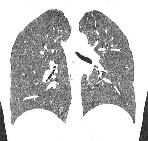 Acute hypersensitivity pneumonitis (Radiopaedia 85293-100870 Coronal lung window 79).jpg