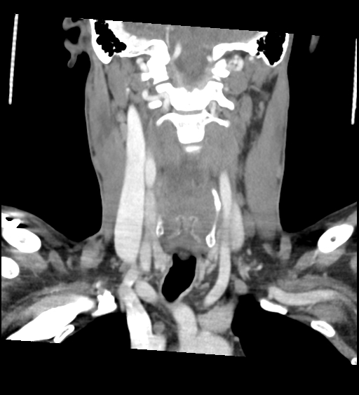Acute longus colli calcific tendinitis (Radiopaedia 72495-83036 Coronal C+ arterial phase 36).jpg