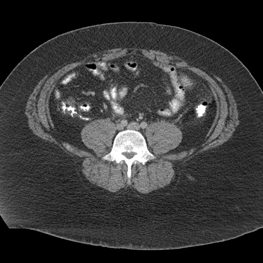 Acute mesenteric venous ischemia (Radiopaedia 46041-50383 Axial C+ portal venous phase 88).jpg