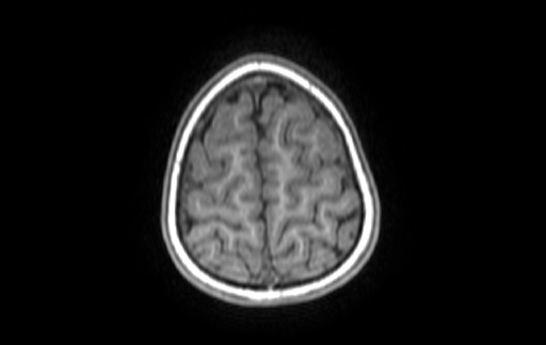Acute necrotizing encephalitis of childhood (Radiopaedia 67356-76737 Axial T1 11).jpg