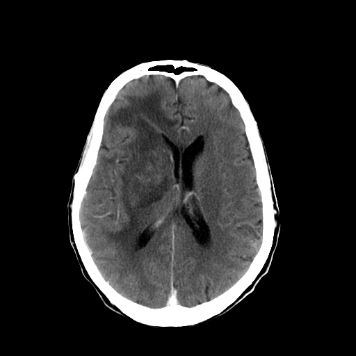 File:Acute necrotizing toxoplasma encephalitis (Radiopaedia 10683-11150 C+ arterial phase 14).jpg