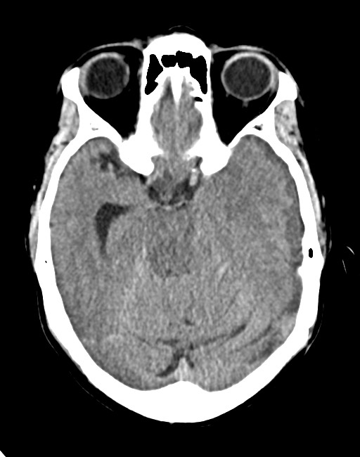 Acute on chronic subdural hematoma (Radiopaedia 74814-85823 Axial non-contrast 38).jpg