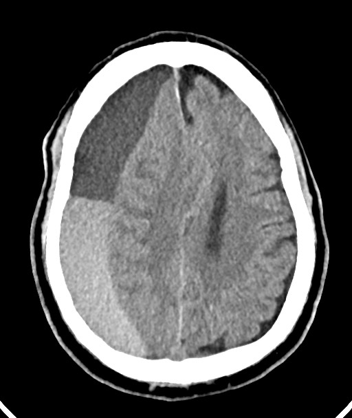 Acute on chronic subdural hematoma (Radiopaedia 78346-90966 Axial non-contrast 41).jpg