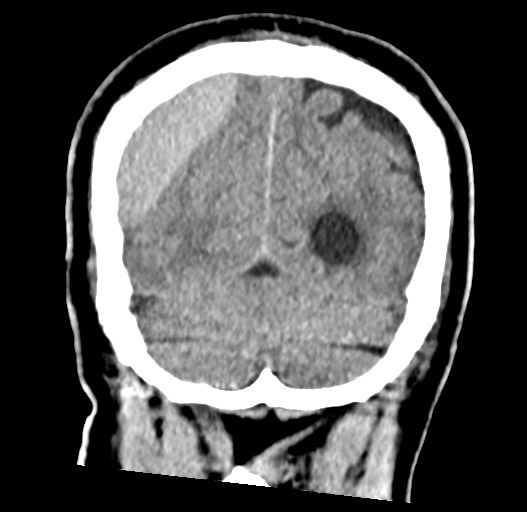 Acute on chronic subdural hematoma (Radiopaedia 78346-90966 Coronal non-contrast 54).jpg
