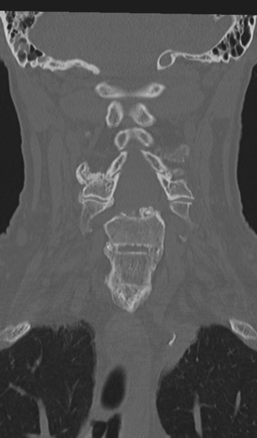 Acute on chronic subdural hematoma and thoracic vertebral injury in a multitrauma patient (Radiopaedia 31698-32619 Coronal bone window 30).jpg