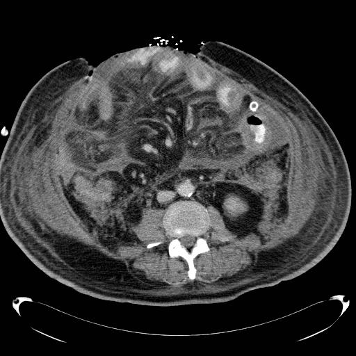 Acute pancreatic necrosis (Radiopaedia 13560-18503 Axial C+ portal venous phase 45).jpg