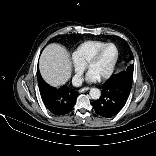 File:Acute pancreatitis (Radiopaedia 85146-100701 Axial C+ portal venous phase 10).jpg