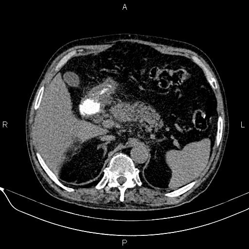 Acute pancreatitis (Radiopaedia 85146-100701 Axial non-contrast 37).jpg