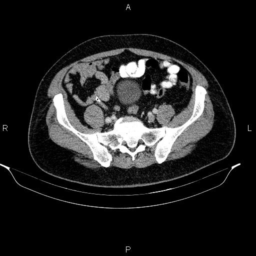 Acute pancreatitis (Radiopaedia 85390-101010 Axial C+ portal venous phase 82).jpg