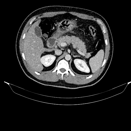 Acute pancreatitis (Radiopaedia 87428-103757 Axial C+ portal venous phase 35).jpg