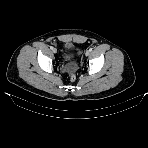 File:Acute pancreatitis (Radiopaedia 87428-103757 Axial C+ portal venous phase 87).jpg