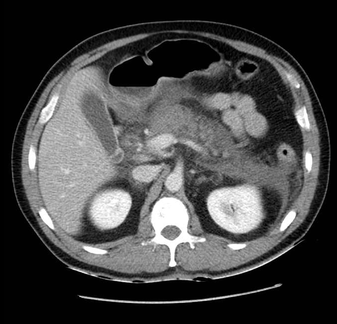 Acute pancreatitis - Balthazar E (Radiopaedia 23080-23110 Axial C+ portal venous phase 22).jpg
