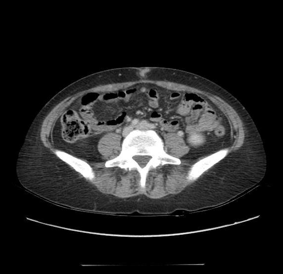 Acute pancreatitis - Balthazar E - post ERCP (Radiopaedia 27562-27772 Axial C+ portal venous phase 47).png