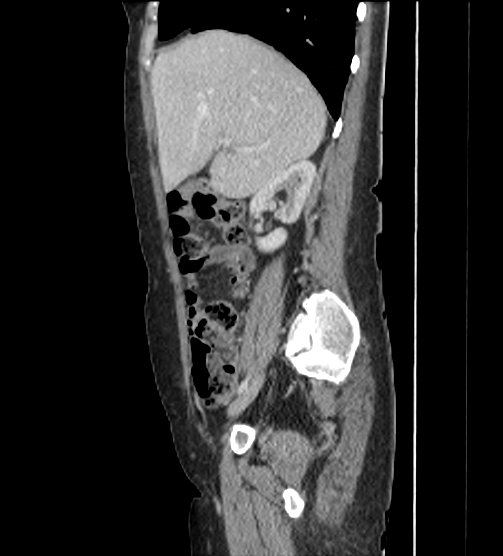 File:Acute pancreatitis - Balthazar E - post ERCP (Radiopaedia 27562-27772 Sagittal C+ portal venous phase 37).png