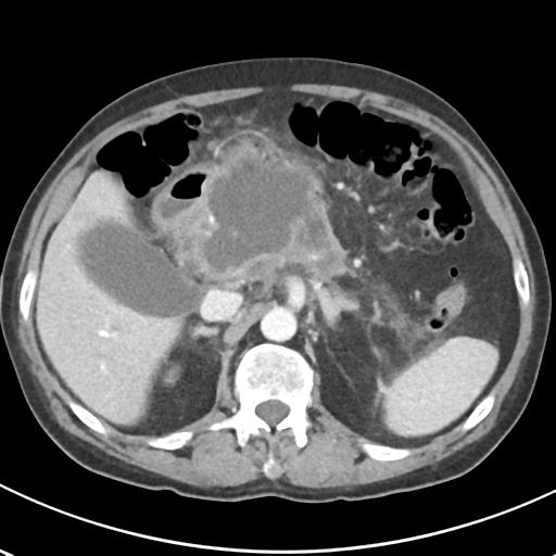 File:Acute pancreatitis and walled-off necrosis (Radiopaedia 29888-30404 Axial C+ portal venous phase 26).jpg