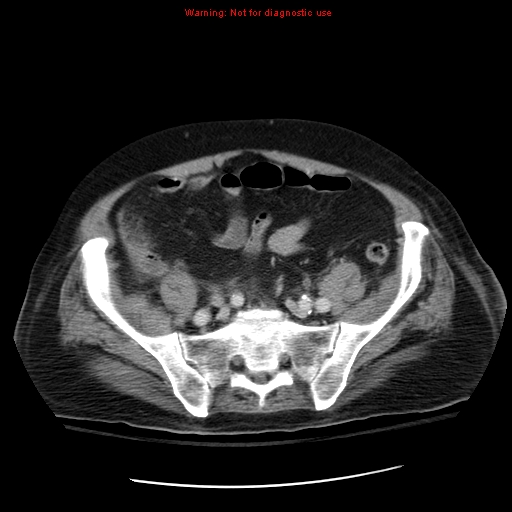 File:Acute pancreatitis with incidental pancreatic lipoma (Radiopaedia 10190-10730 Axial C+ portal venous phase 59).jpg