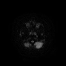 File:Acute phase of hemiconvulsion-hemiplegia epilepsy syndrome (Radiopaedia 29309-29745 Axial DWI 4).jpg