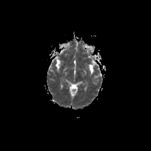 File:Acute pontine infarct from vertebral artery dissection (Radiopaedia 34111-35370 Axial ADC 10).png
