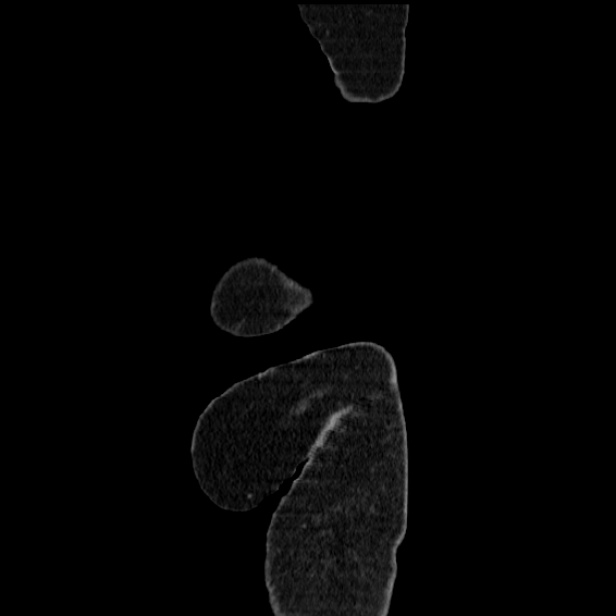 Acute pyelonephritis (Radiopaedia 25657-25837 Sagittal renal parenchymal phase 82).jpg
