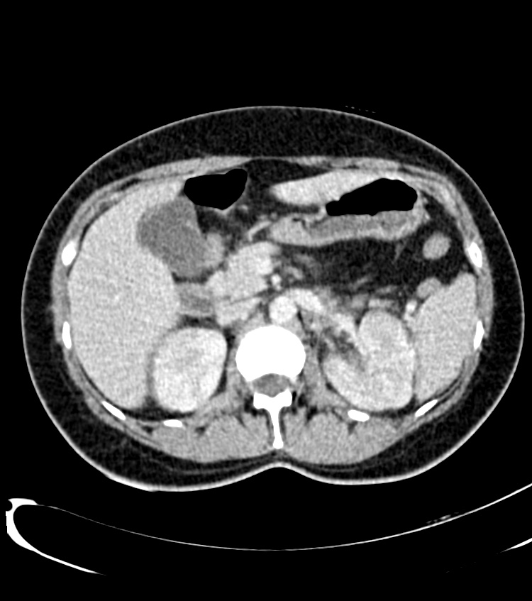 Acute pyelonephritis (Radiopaedia 40264-42816 Axial C+ portal venous phase 14).jpg