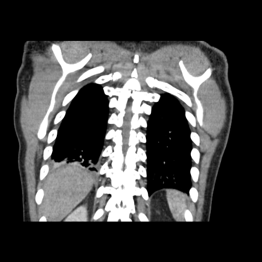 Acute segmental pulmonary emboli and pulmonary infarction (Radiopaedia 62264-70444 Coronal C+ CTPA 48).jpg