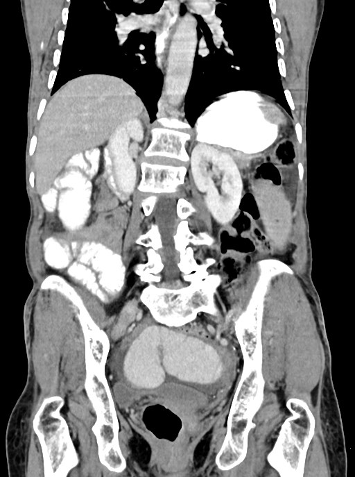 Acute small bowel (ileal) volvulus (Radiopaedia 71740-82139 Coronal C+ portal venous phase 74).jpg
