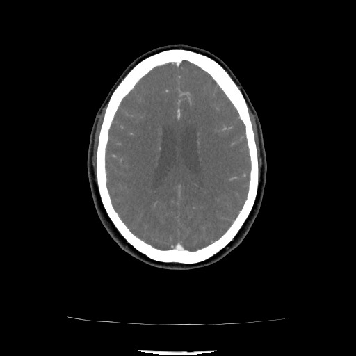 Acute subarachnoid hemorrhage and accessory anterior cerebral artery (Radiopaedia 69231-79009 Axial C+ arterial phase 106).jpg