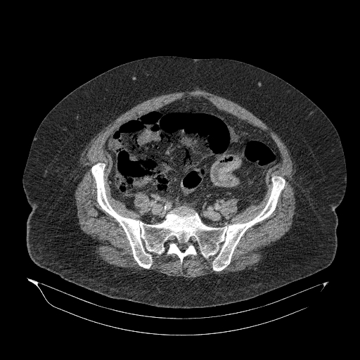 File:Acute superior mesenteric artery occlusion (Radiopaedia 51288-56960 Axial C+ portal venous phase 76).jpg