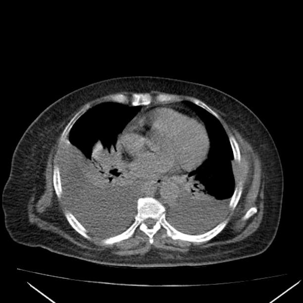 Acute tubular necrosis (Radiopaedia 28077-28334 Axial non-contrast 2).jpg