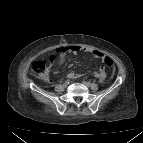 Acute tubular necrosis (Radiopaedia 28077-28334 Axial non-contrast 47).jpg